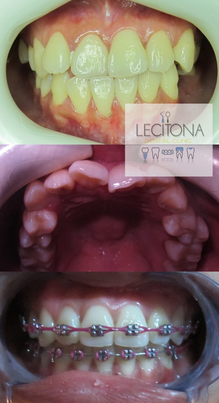 Retention Affordable Braces